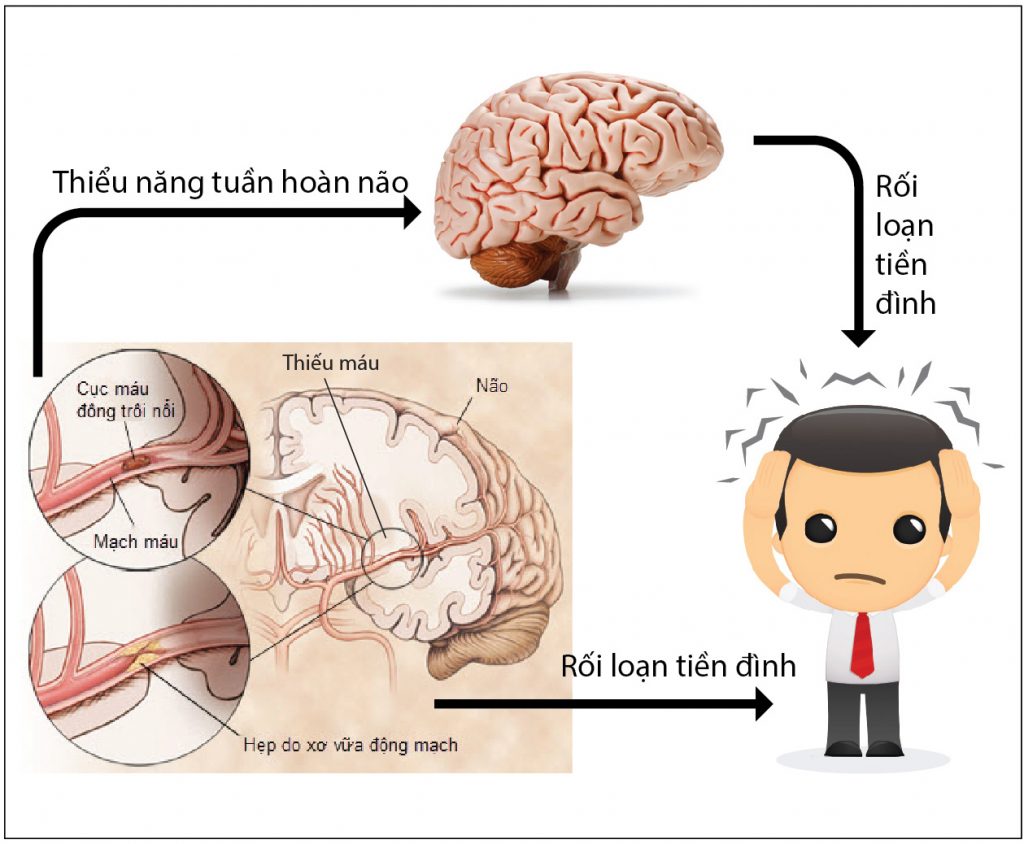 Biểu hiện bệnh rối loạn tiền đình